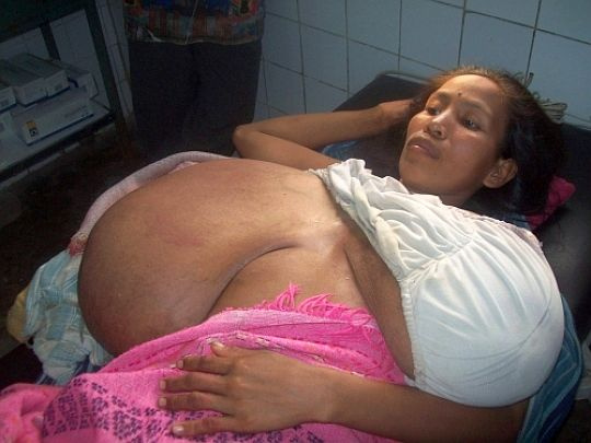 Harmadik gyereke születése után a perui Julia Manihuari szervezetében nem állt le a mellek megnagyobbodásáért felelős hormonok működése, ezért hét év alatt, 29 éves korára akkorára nőtt a melle, hogy képtelen volt tőlük kikelni az ágyából