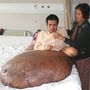 A 90 kilós tumor kétszer olyan nehéz volt, mint a vietnami Nguyen Duy Hai