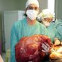 Így néz ki az a 23 kilós tumor, amit egy argentin nőből operáltak ki