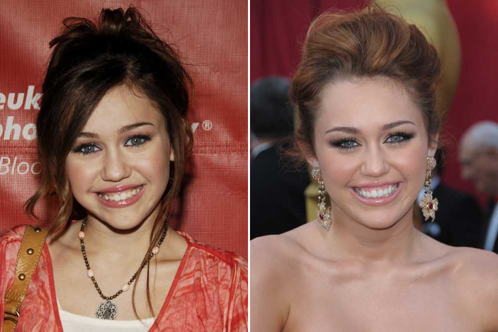 Az alig 18 éves Miley Cyrus-t is azzal gyanúsítják, hogy megműttette az orrát de nincs nyoma műtéti beavatkozásnak a képen. 